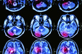 Personal Injury: Traumatic Brain Damage