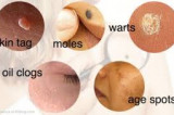A Complete Guide To Removing Warts, Moles, Skin Tags and Oil Clogs Naturally!