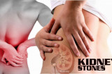 “This is How I Eliminated Kidney Stone in 6 Days”