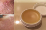Unique Homemade Cream To Get Rid of Scars Completely Within 2 Weeks