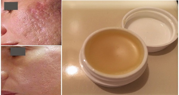 Unique-Homemade-Cream-To-Get-Rid-of-Scars-Completely-Within-2-Weeks