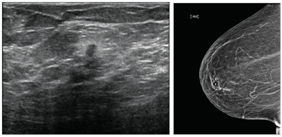 A very small, 3-mm minimal cancer is seen in the ultrasound image (above) and clearly identified on a screening mammogram (right). Cancers found this early on mammograms have the potential of a complete cure.
